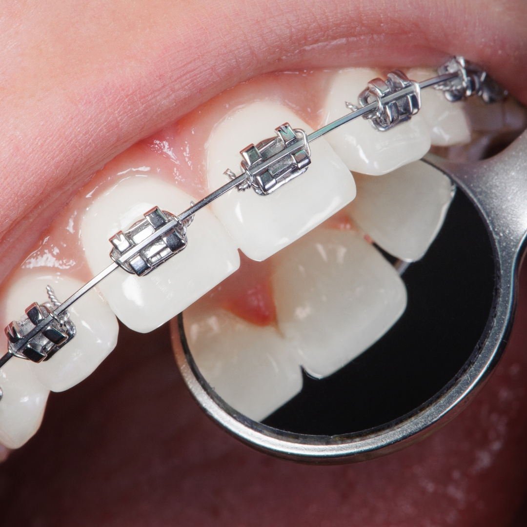 Ortodoncia en Clínica Dental Pacheco Hidalgo, Sevilla
