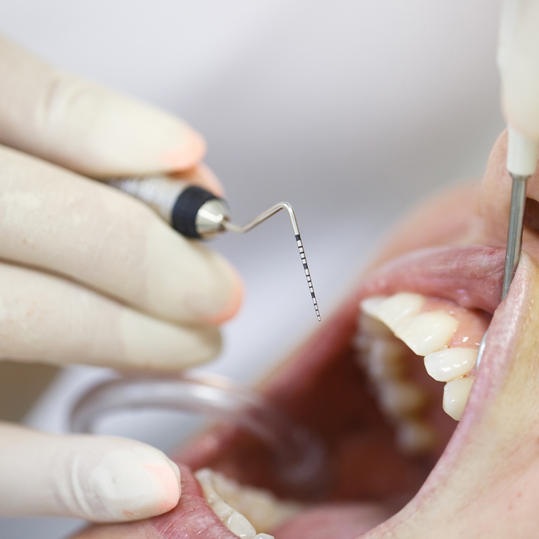 Periodoncia en dentista Sevilla Pino Montano